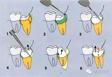 口腔拔牙图片,口腔拔牙麻醉多久消退