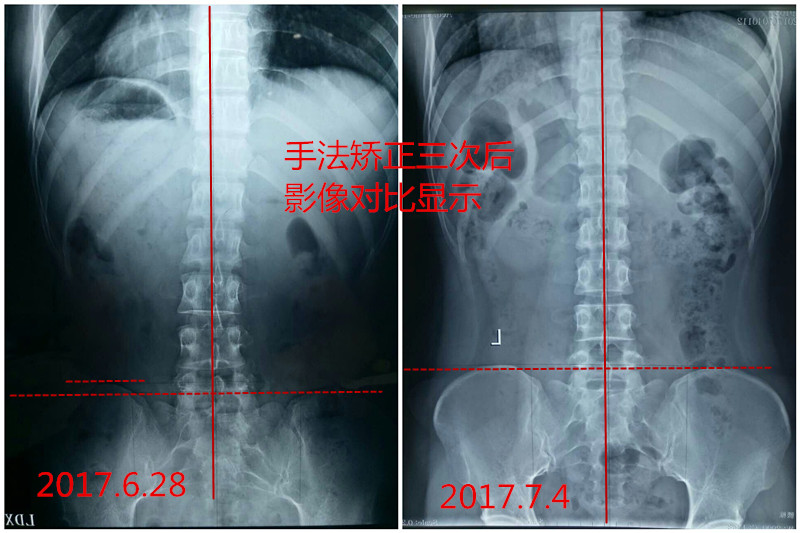 脊椎变形可以自行矫正,脊椎变形矫正视频