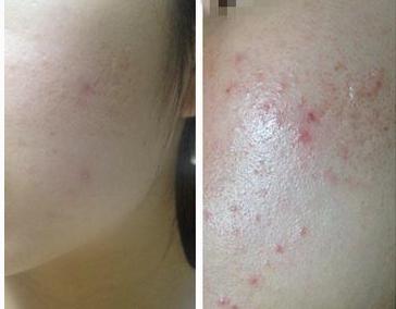 下巴反复长痘痘的原因和解决方法,下巴长期长痘痘的原因和解决方法