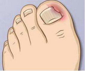 脚趾甲长肉里？不拔甲，1招帮你轻松治！