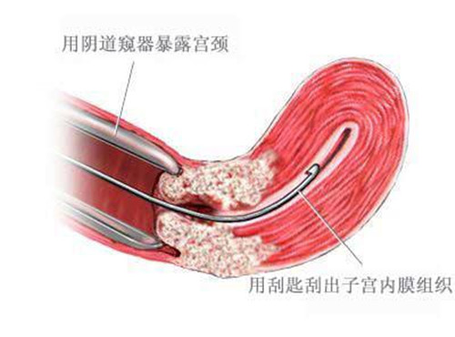 节育环如果不取有什么危害,节育环残留体内无影响是真的吗