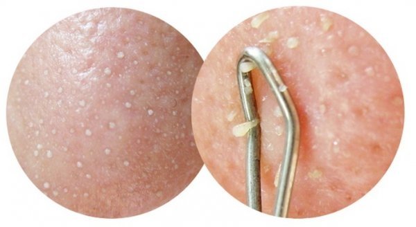 为什么脸上老是长痘粉刺怎么解决,脸上长粉刺怎么办最有效的方法