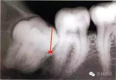 口腔拔牙图片,口腔拔牙麻醉多久消退