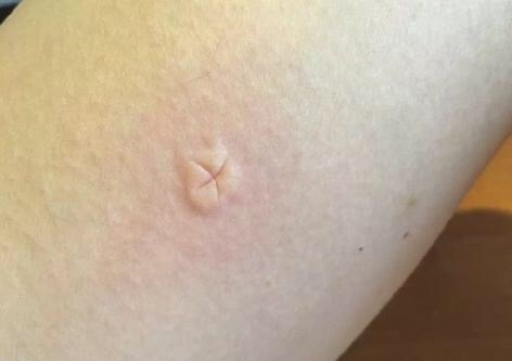 不再担心宝宝被蚊子咬了,宝宝被蚊子咬的正确处理方法