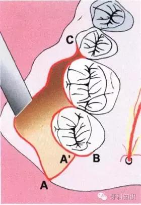 口腔拔牙图片,口腔拔牙麻醉多久消退