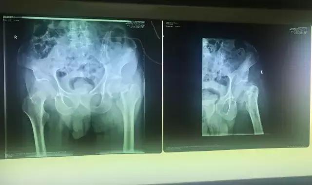 老人胯部粉碎性骨折,老人胯骨骨折最佳手术时间