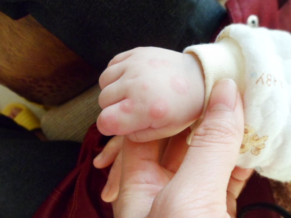 手足口病会传染吗怎么预防,手足口病的病后该如何护理