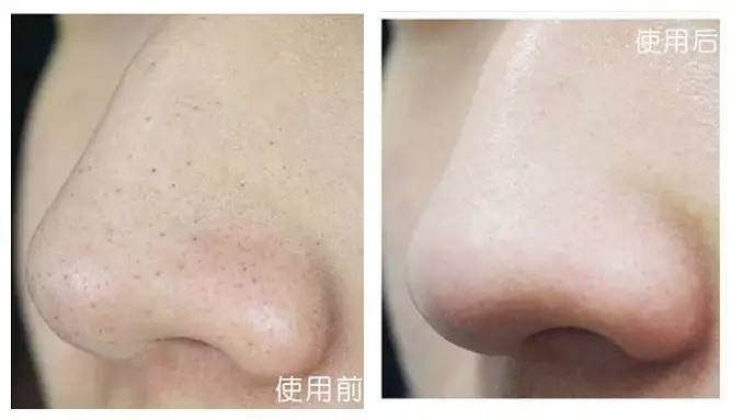 “黑头”这个渣男，彻底和他Say byebye~