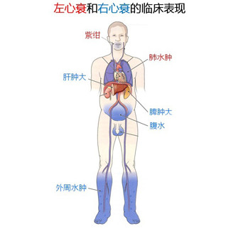 熟睡中因憋气而惊醒、呼吸困难，这些都是心力衰竭的症状，它发病率高，病残、病逝几率也高