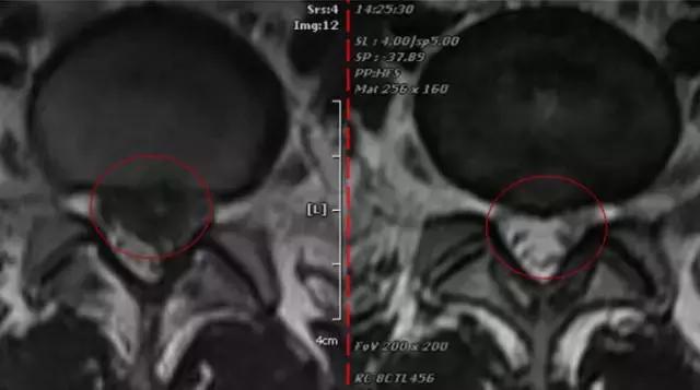 《1039生活馆》之“健康导医”：腰突手术如何不再“伤筋动骨”？