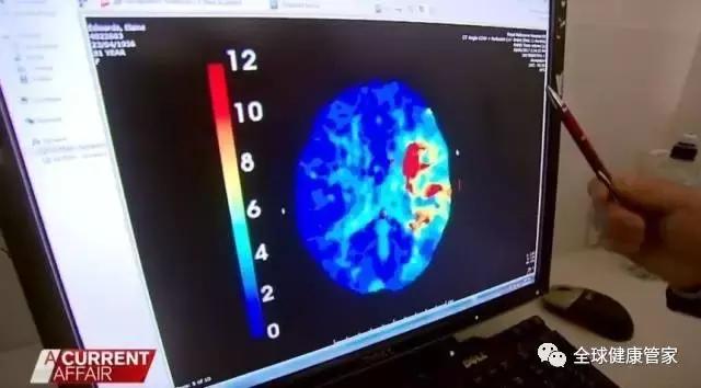 澳洲治疗中风可怕副作用,澳洲十大黑科技药