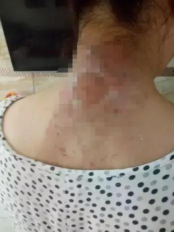 肩周贴老膏药,肩周受凉了膏药贴肩周反而更疼了