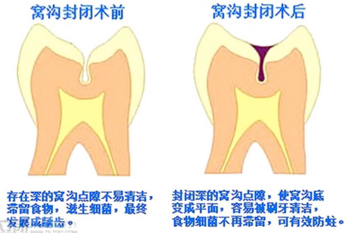 中老年人蛀牙太多怎么办,成年人龋齿有必要治吗