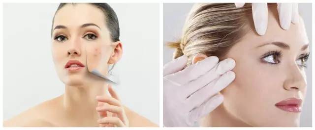 十年战痘血泪史详解,战痘知识分享