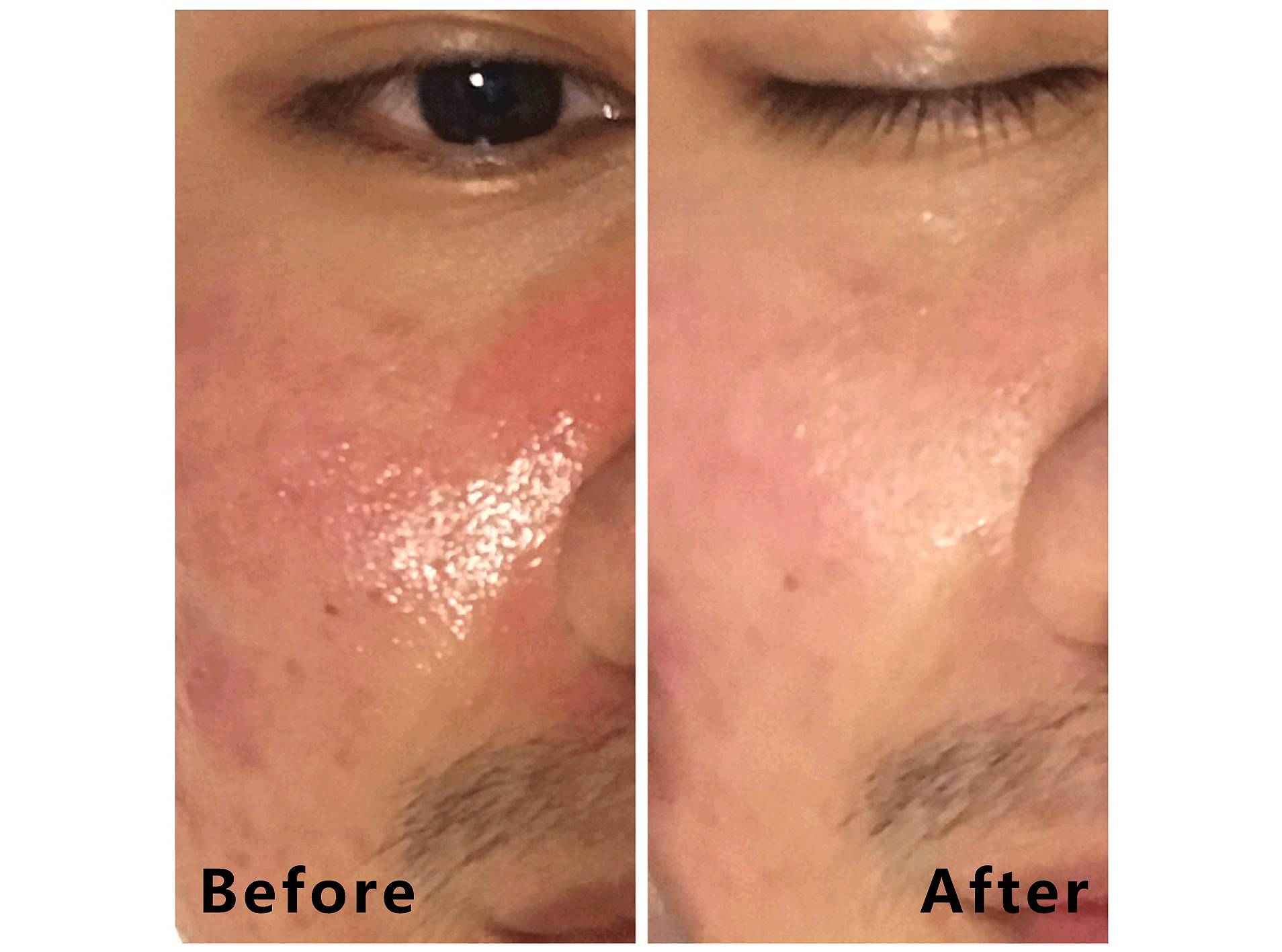 我的祛斑血泪史完整版,我的祛痘史