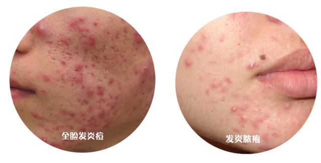 战痘大结局完整版,战痘合集完整版