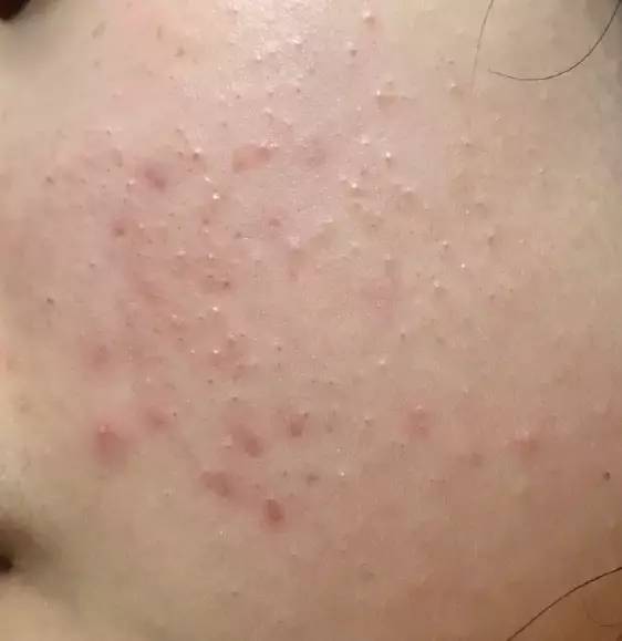 十年战痘血泪史详解,战痘知识分享