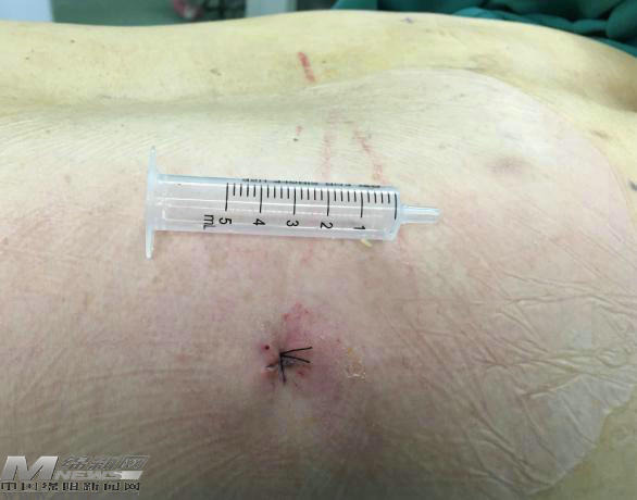 绵阳科学城医院腰间盘突出手术,绵阳腰椎间盘突出手术