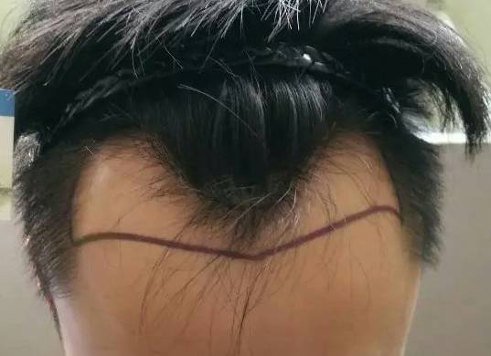 严重脱发秃顶发际线后移如何改善,长期熬夜导致发际线后移秃顶脱发