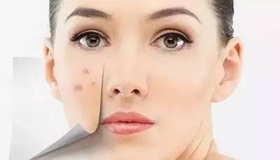 祛痘印用什么激光祛痘好,激光祛痘印痘坑能彻底去掉痘痘吗