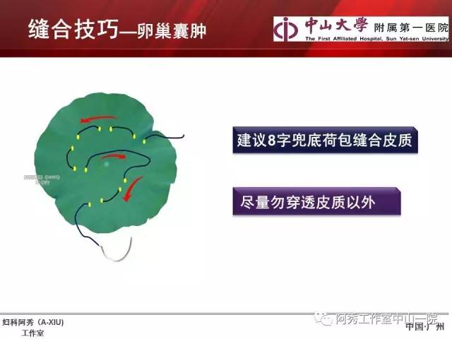 妇科腹腔镜下常用缝合技巧
