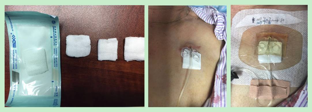 杈撴恫娓澏褰㈤拡绌垮埡瑙嗛,铦剁考閽堝埡鍏ヨ緭娑叉腐鎿嶄綔娴佺▼