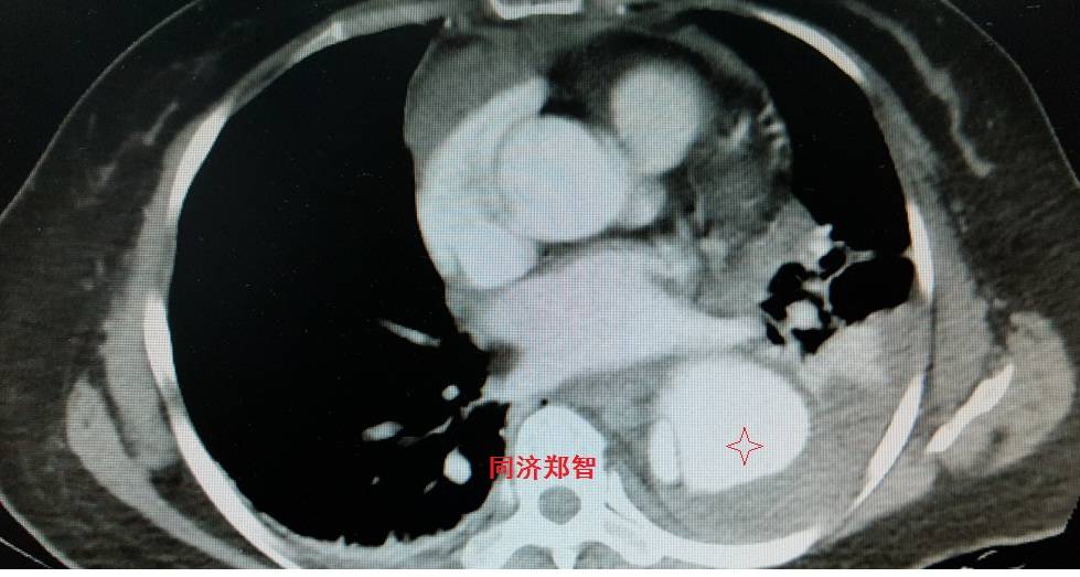 急性主动脉夹层cta影像诊断与鉴别,冠状动脉cta可以看到主动脉夹层吗
