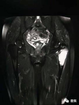 髋部疼痛做什么检查,左髋部疼痛待查病例