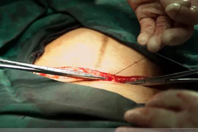 剖腹产全景记录,剖腹产恢复不同时期的照片