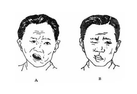 面瘫不恢复是因为风没出来吗,面瘫都是风的原因吗