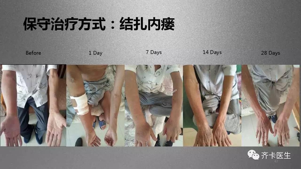 颈部血透导管一般是长期还是临时,颈内静脉临时导管的固定