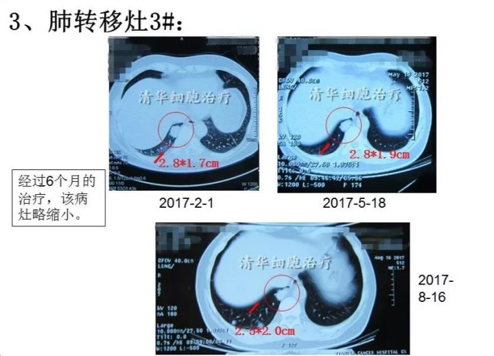 nkt治疗是免疫治疗吗,nkt治疗案例