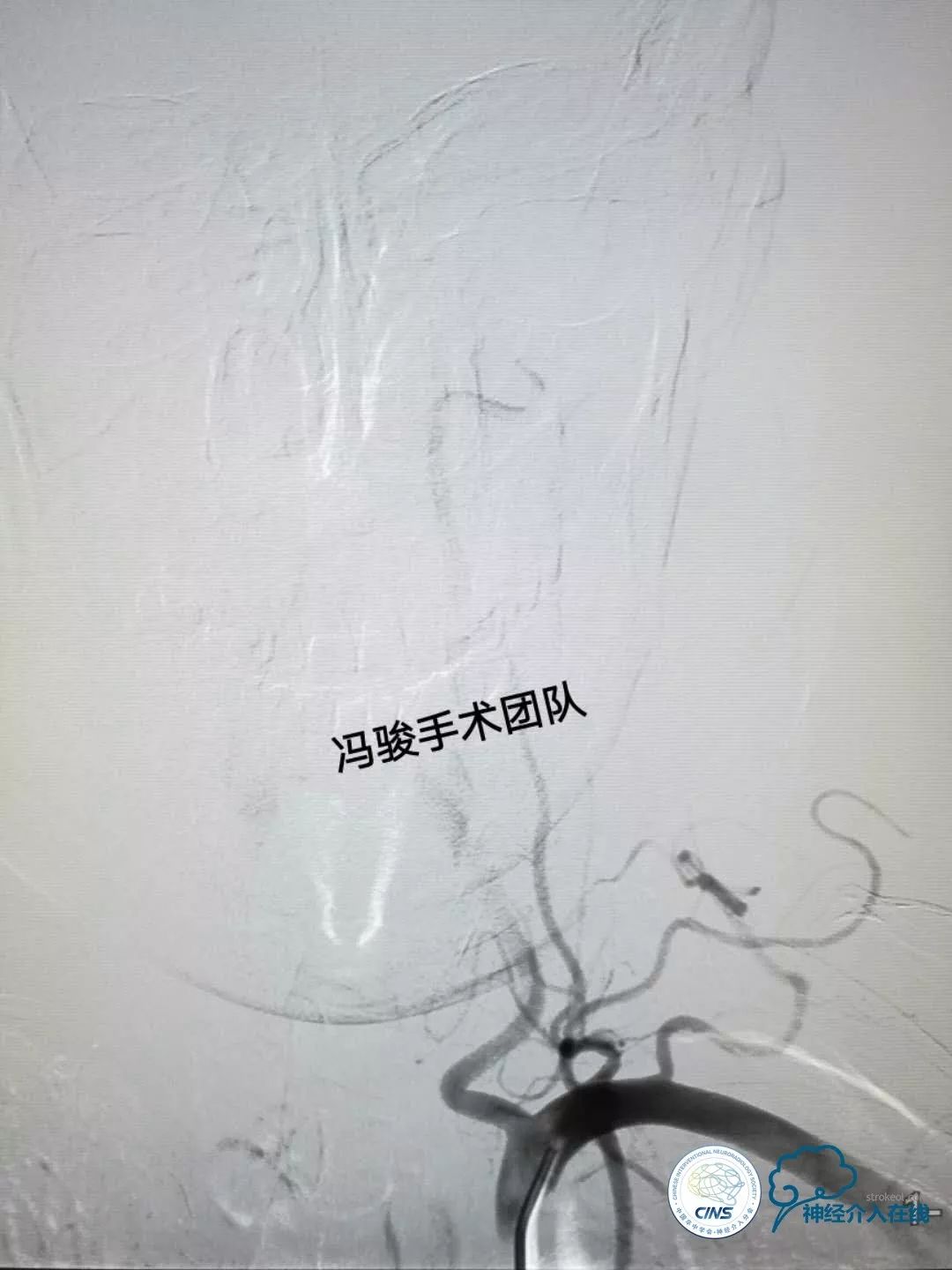 天新福—百家百言｜一例孤独椎动脉V4段并PICA重度狭窄支架手术及1年随访