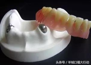 拔牙后镶牙的最佳时间,拔牙后镶牙最佳时间表