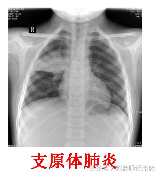 儿童支原体肺炎阿奇7天不管用,儿童肺炎阿奇霉素为什么用2-3周