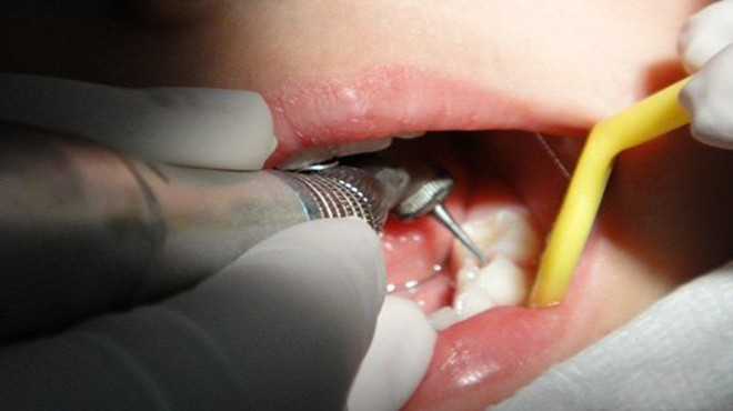 牙齿有黑洞怎么办?医生说这样做可缓解疼痛