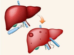 丙肝难治吗丙肝的治疗方法,丙肝特效药有医保吗