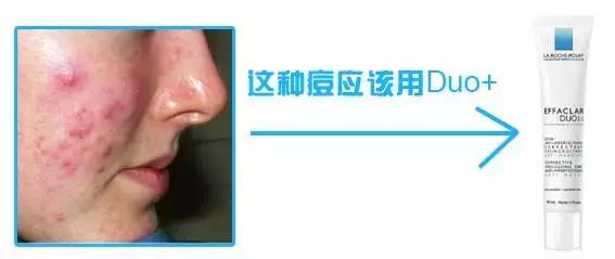 痘痘闭口痘印黑头,痘痘闭口毛孔粗大修复