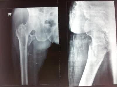 股骨粗隆间骨折的护理问题及措施,股骨粗隆骨折临床指南