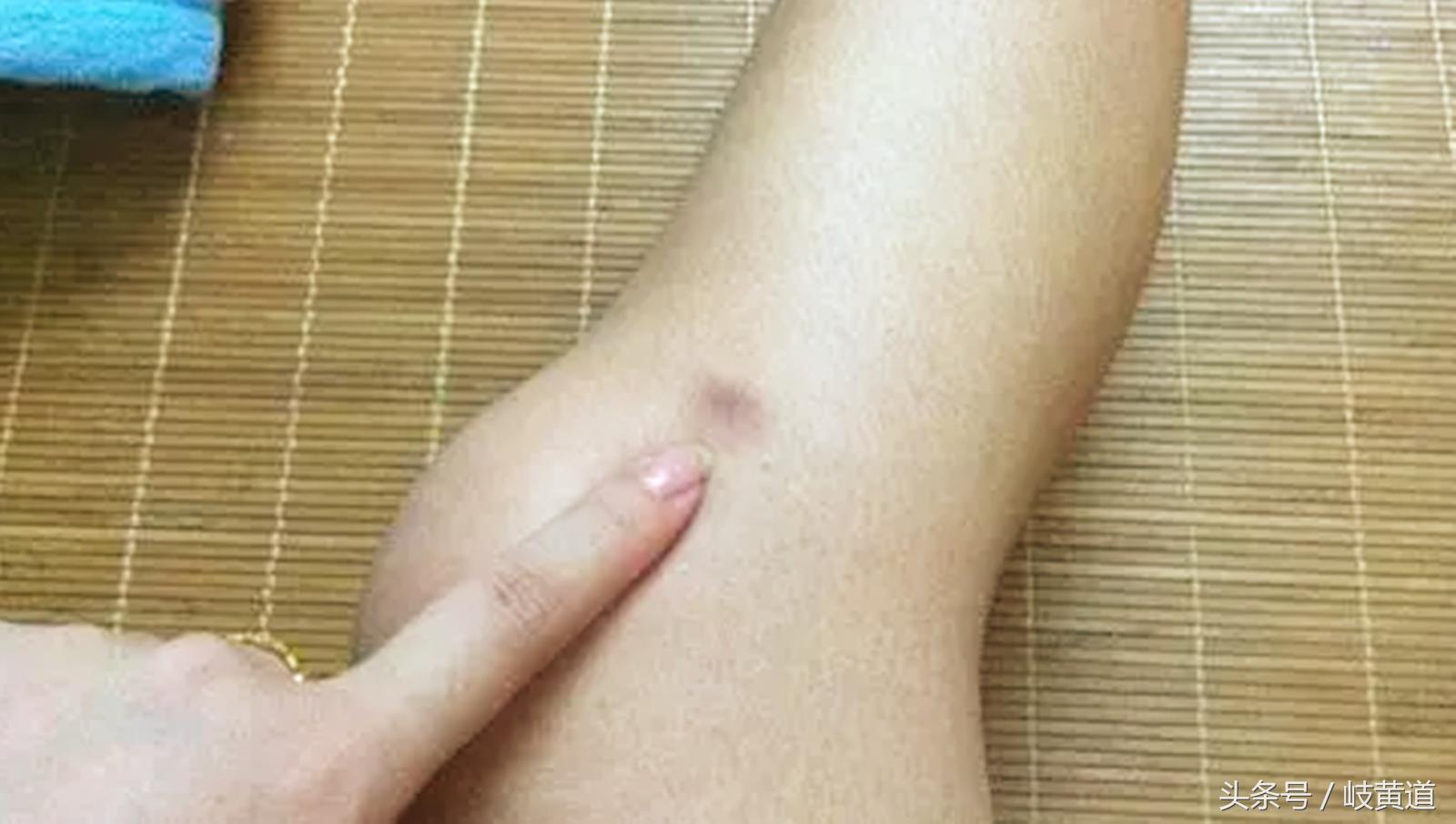 俗话说的鬼捏青是怎么回事,鬼掐青是什么