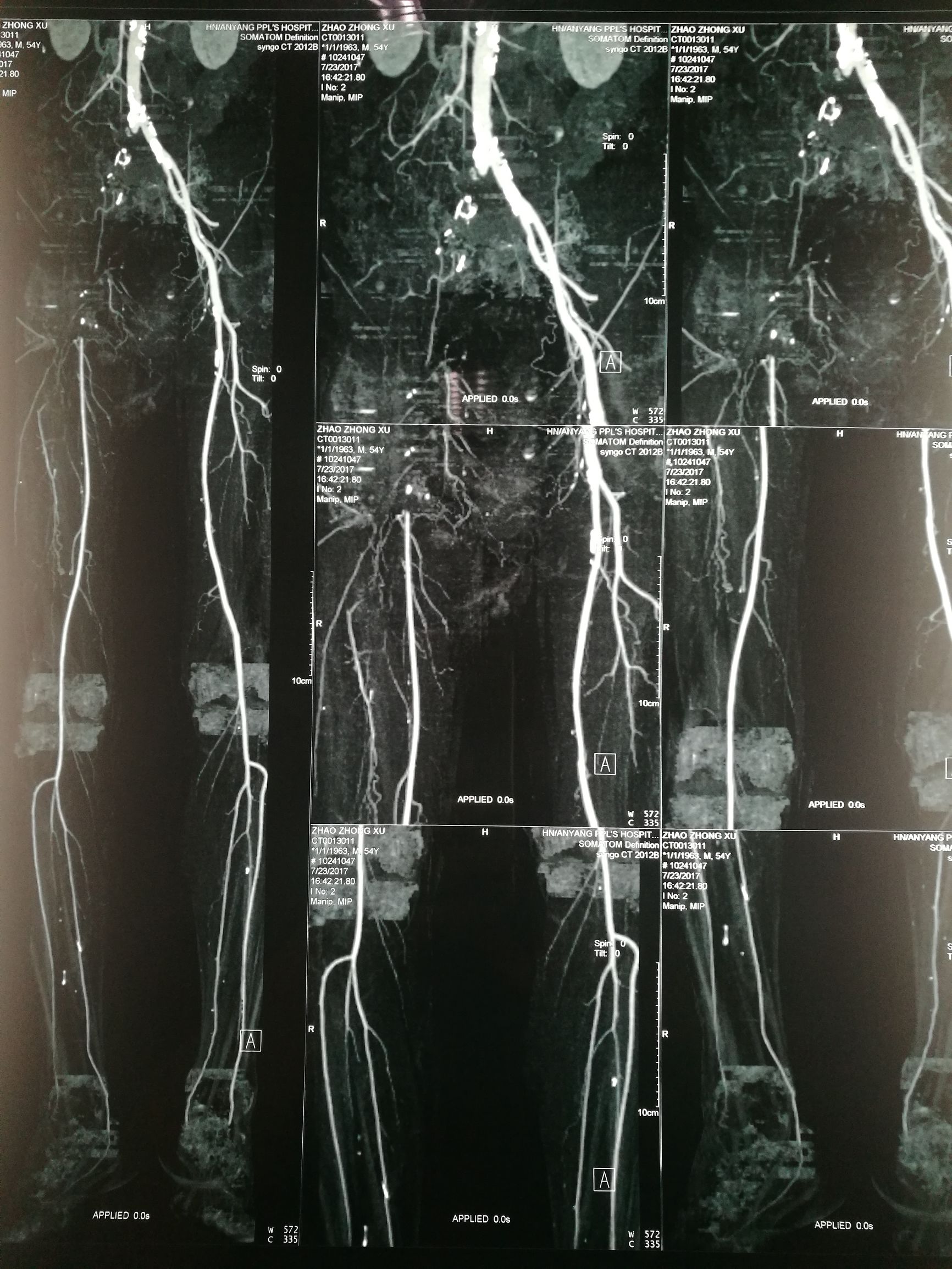 治下肢血栓闭塞脉管炎中药方,下肢动脉慢性血栓闭塞