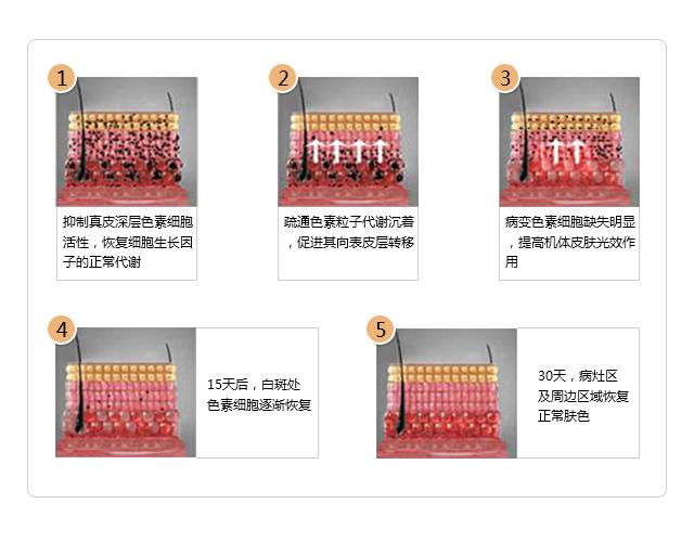 国际目前最有效的治疗白癜风,中国治疗白癜风顶级专家