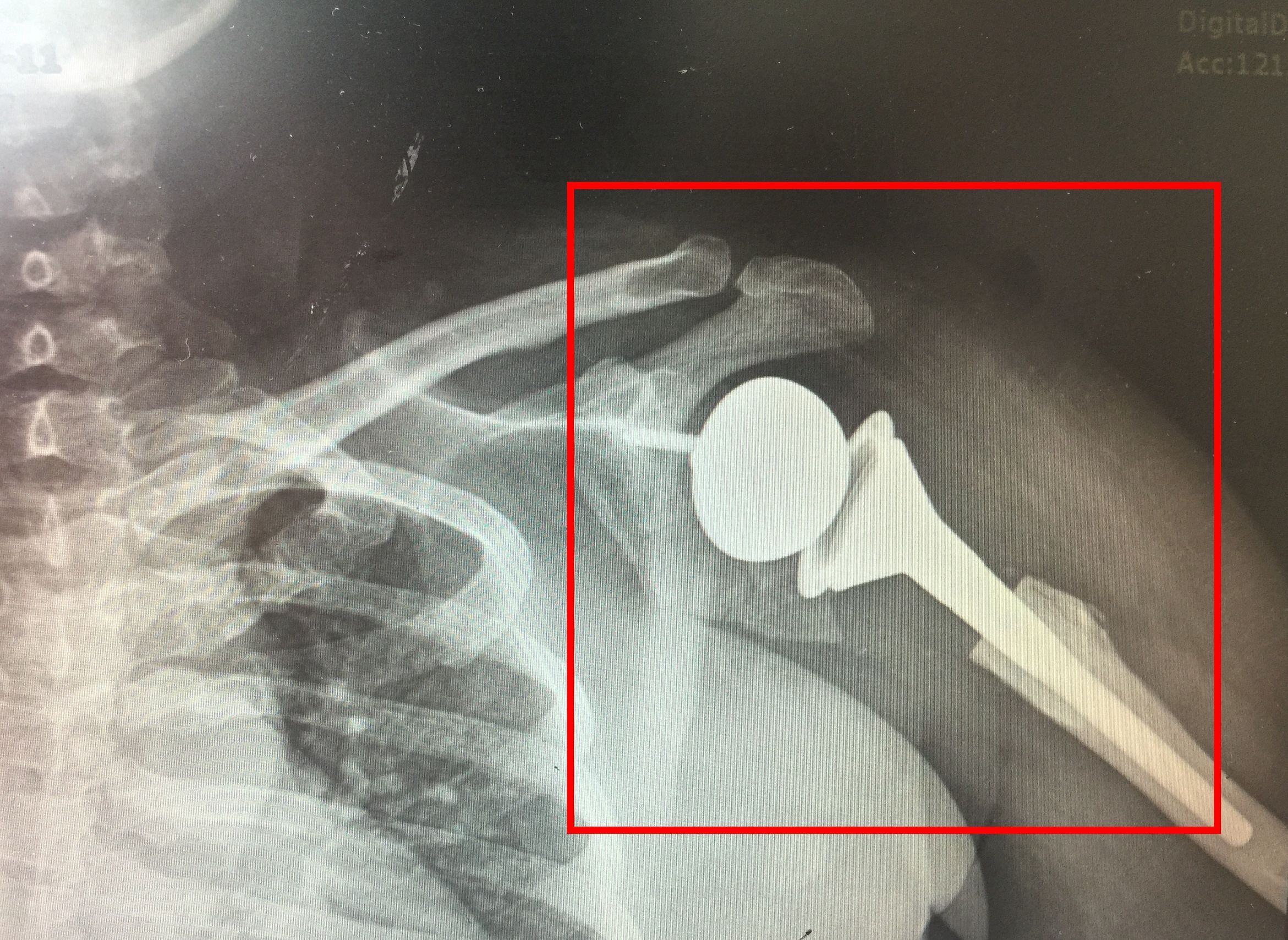 为什么骨折三个月了骨头还没长好,为什么骨折之后骨头少一块