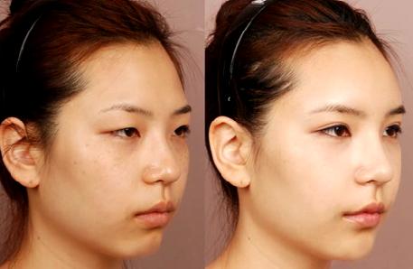 玻尿酸美容的正确方法,玻尿酸又称午餐式美容