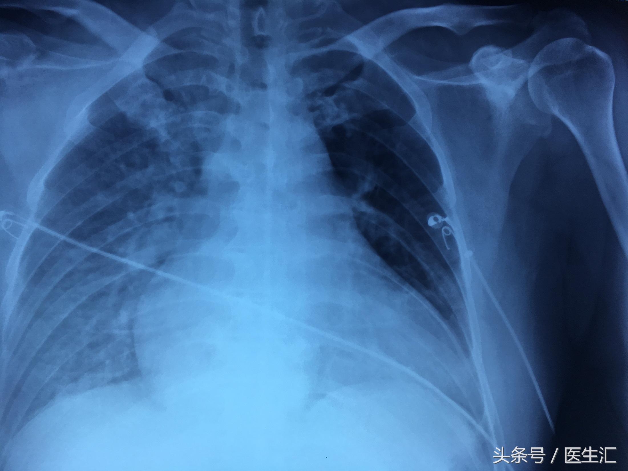 喝白酒后呼吸困难怎么回事,喝啤酒呼吸困难怎么回事