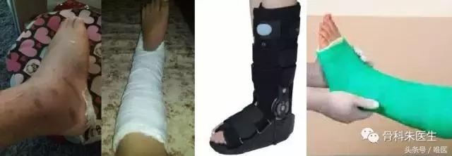 踝关节骨折没有手术怎么办,骨折保守治疗可以活动踝关节吗