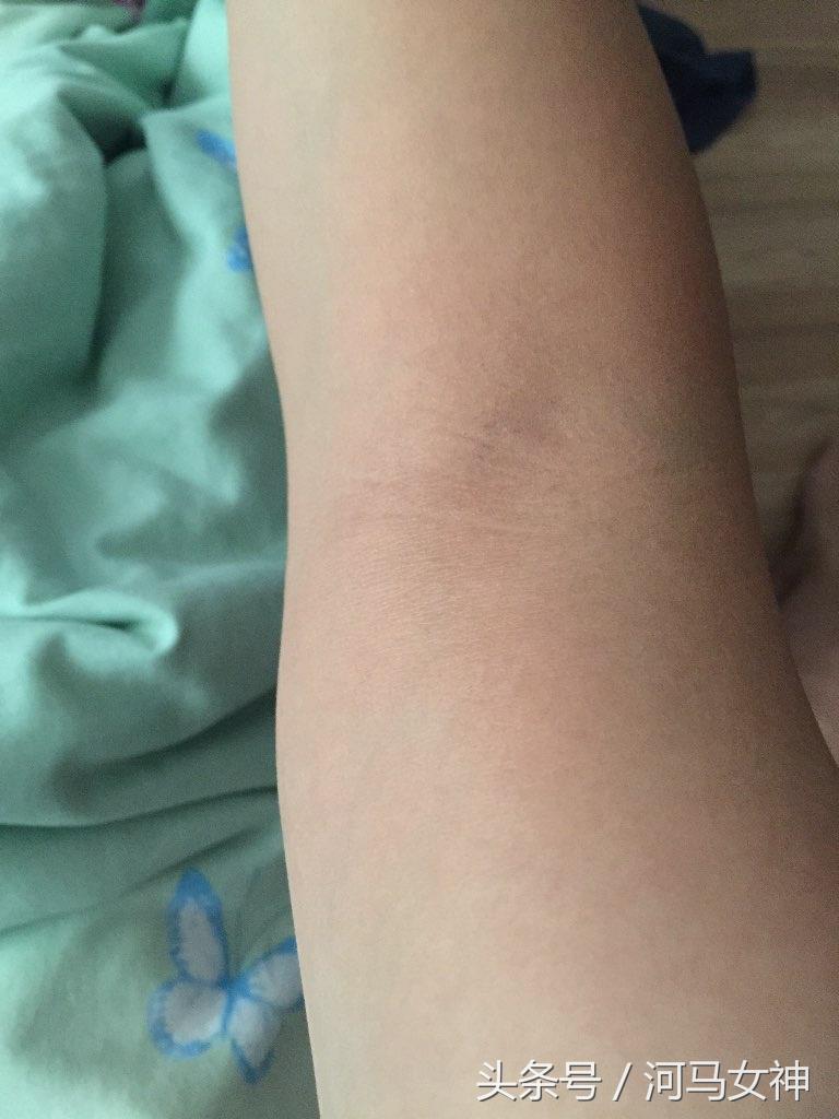 严重过敏反应首选的药物,对药物过敏反应