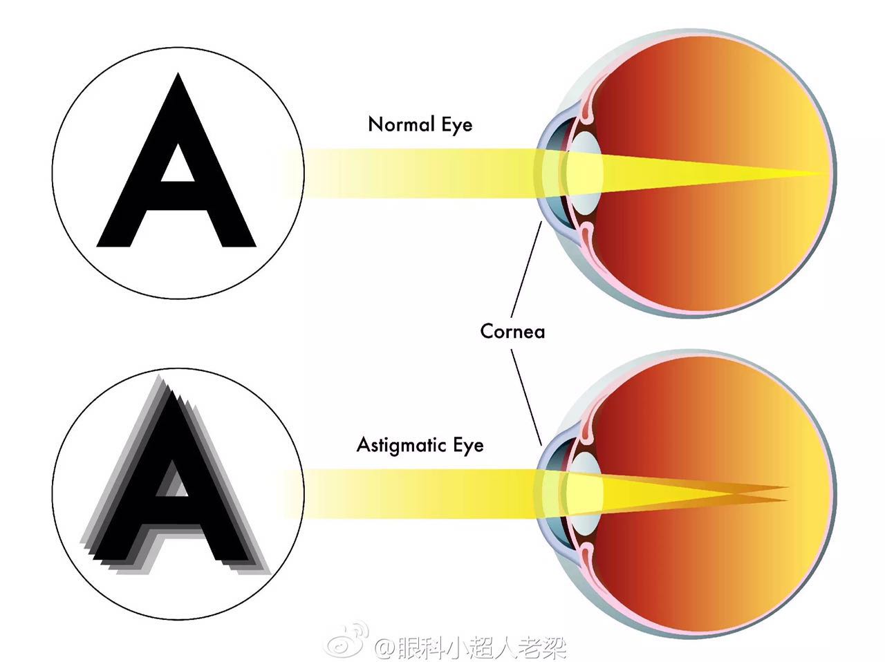 儿童近视眼家长也不用太焦虑,孩子散光几岁治疗最好