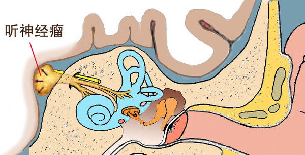 长期出现耳鸣吃什么药好,长期失眠为什么单侧耳鸣厉害