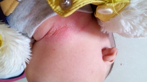 防止宝宝脖子被淹擦什么,宝宝脖子被淹为什么要用茶水洗